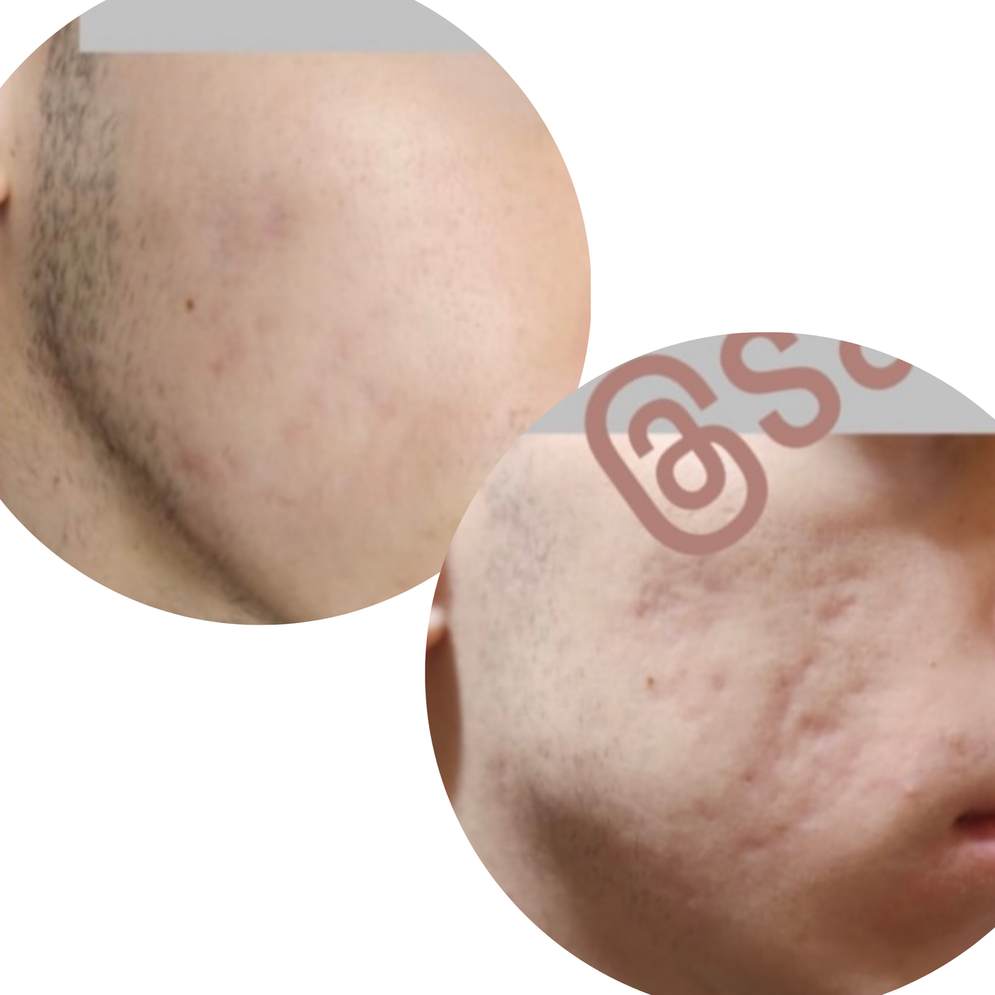 Sabral Akne Skarı Karşıtı Set