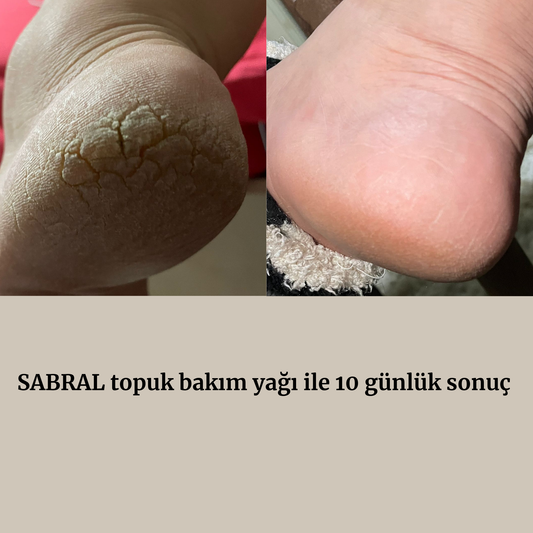 SABRAL TOPUK BAKIM YAĞI 10 GÜNLÜK KULLANIM SONUCU 