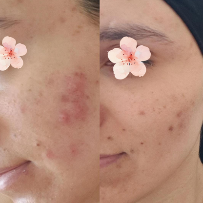 Sabral Akne Ve Sivilce Karşıtı Bakım Seti