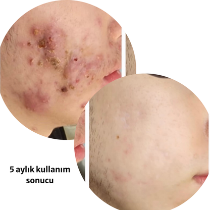 Sabral Akne Skarı Karşıtı Set